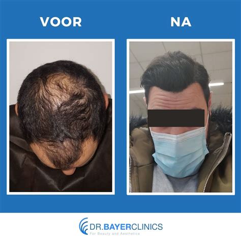 Haartransplantatie Voor En Na: De Rol Van Haar Verzorging