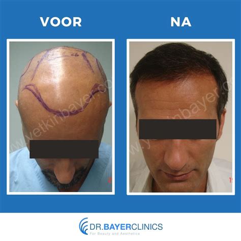 Haartransplantatie Voor En Na: Professionele Adviezen En Tips