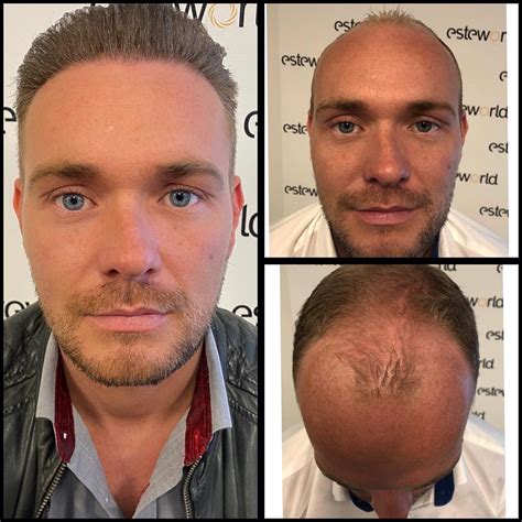 Persoonlijke Ervaringen Met Haartransplantatie