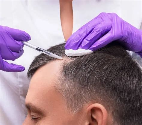 De Beste Haartransplantatie Methoden Van 2023