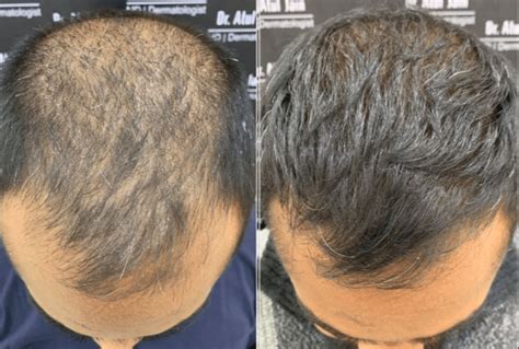 De Voor- En Nadelen Van Haartransplantatie