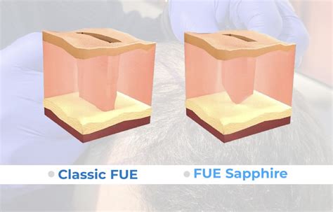 Saffier FUE: De Innovatieve Haartransplantatiemethode