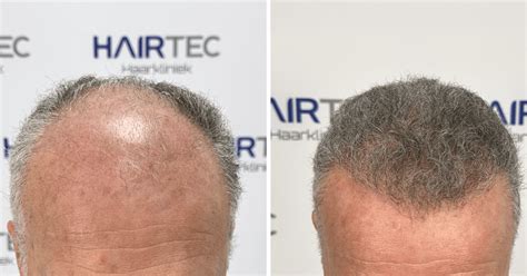 Waarom Duurt Haartransplantatie Zo Lang?